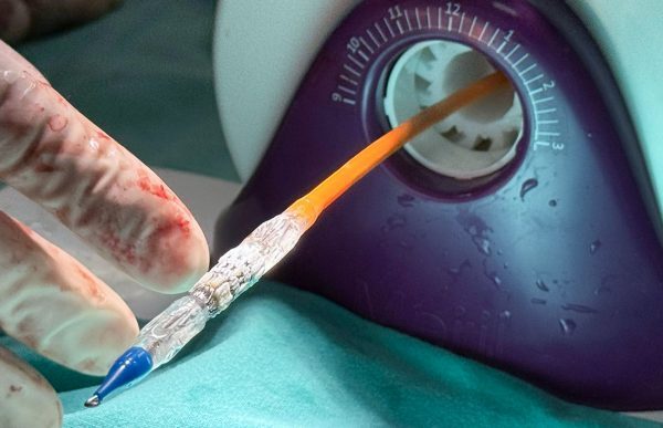 Una Zapalina recibió una válvula pulmonar percutánea, primera intervención de este tipo que se realiza en la Patagonia